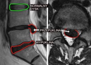 Unikaj tych czynności: czego nie wolno robić przy dyskopatii lędźwiowej