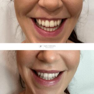 Jak długo po botoksie należy unikać kładzenia się?